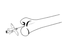 Intraosseous Infusion Needle 18g Bone Marrow Jorvet